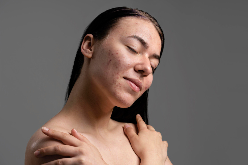 Tips Mengatasi Kulit Kering Saat Cuaca Dingin: Cara Mudah
