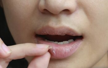 Cara Mengatasi Bibir Pecah-pecah Secara Alami dan Rahasia