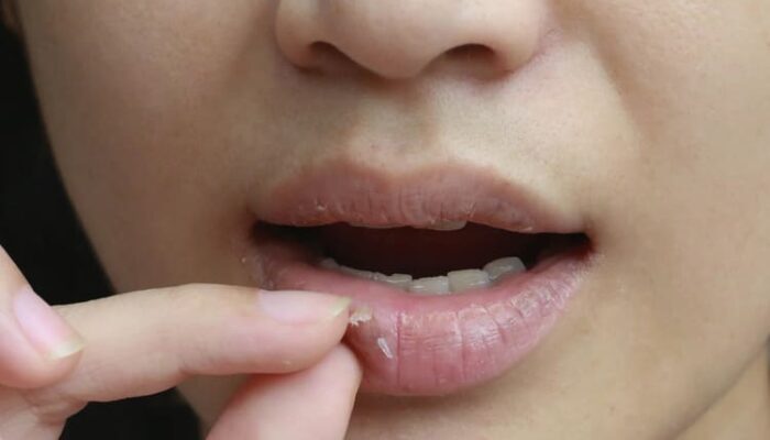 Cara Mengatasi Bibir Pecah-pecah Secara Alami dan Rahasia