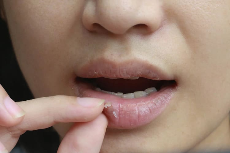 Cara Mengatasi Bibir Pecah-pecah Secara Alami dan Rahasia